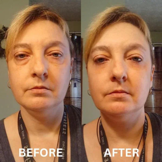 InstantLift Eye Patches