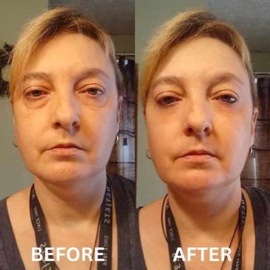 InstantLift Eye Patches