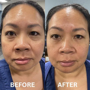 InstantLift Eye Patches