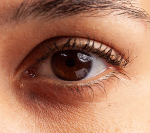 Dark Circles